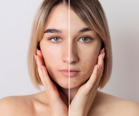 Pigmentation Treatment Image